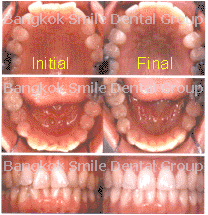 Invisalign Patient Bangkok Thailand tooth laser implant