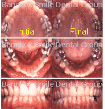 Invisalign Patient Bangkok Thailand dentist teeth whitening
