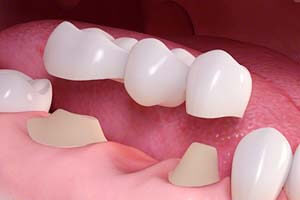Dental Crowns/Bridges