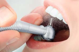 Dental Teeth Cleaning