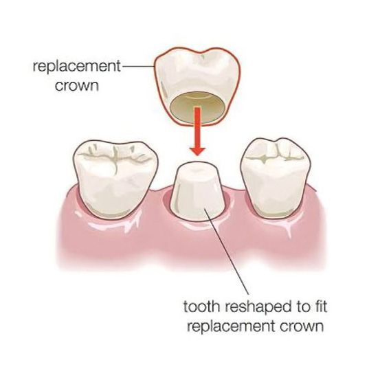 Dental Crown and Dental Bridge by Bangkok Smile Dental Clinic.