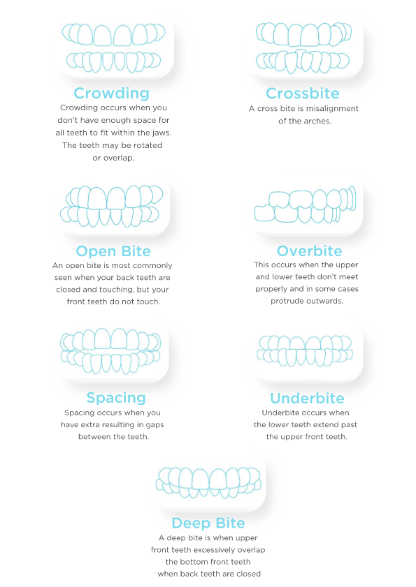 Invisalign Bangkok | Dental Cosmetic by Bangkok Smile Dental Clinic in ...