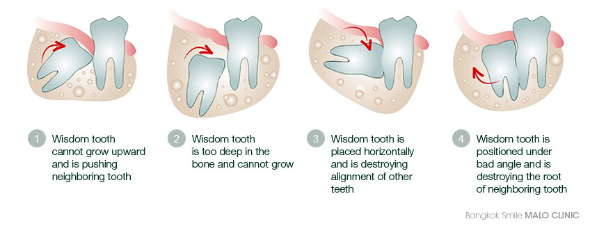 wisdom teeth coming in horizontally