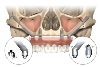 The NobelZYGOMA - A Graftless Solution