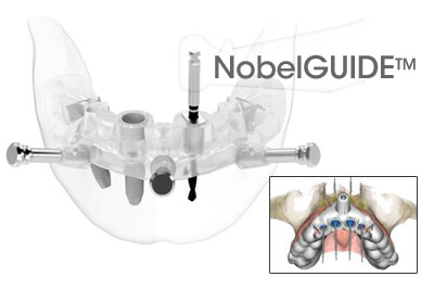 NobelGUIDE™ - Predictable Implant Placement