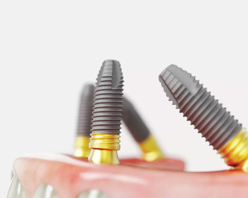 The NobelSpeedy® - Immediate Function Dental Implant